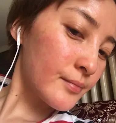 高原红长沙怎么治_高原红长沙医院哪家好