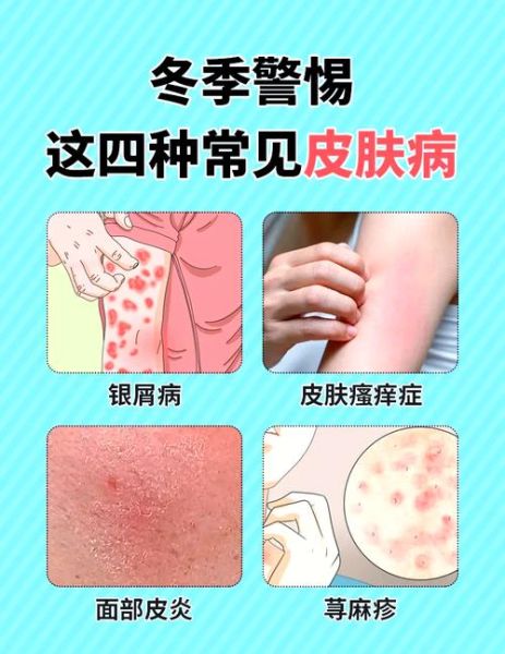 高原皮肤病有哪些症状_如何预防高原皮肤病