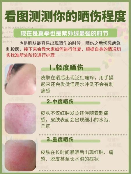 高原晒伤脱皮怎么办_高原晒伤后多久恢复