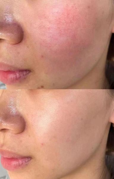 高原反应皮肤红怎么办_高原脸发红多久能退