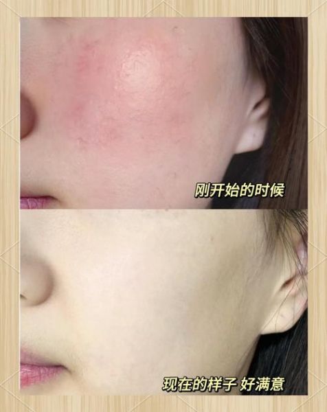 高原反应皮肤红怎么办_高原脸发红多久能退