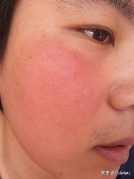 高原红图片_高原红怎么消除