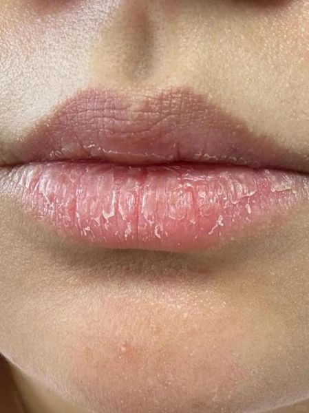 高原上嘴唇发紫干裂怎么办_如何预防