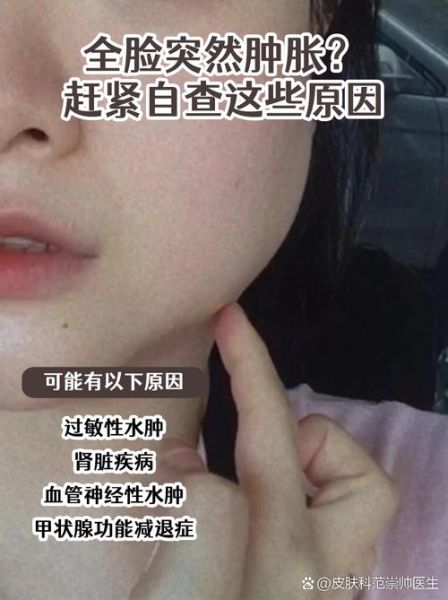 高原反应脸浮肿怎么办_高原脸肿多久能消