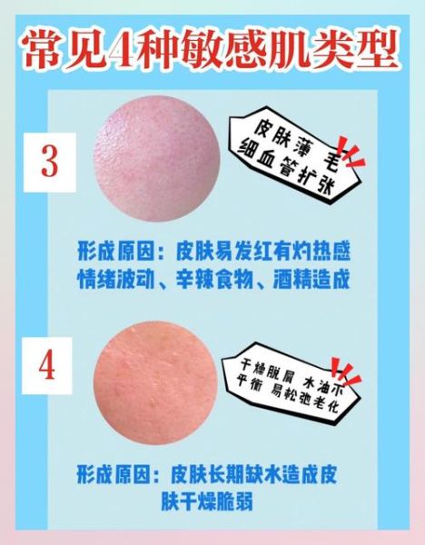 高原红怎么去掉_去除天生高原红的方法