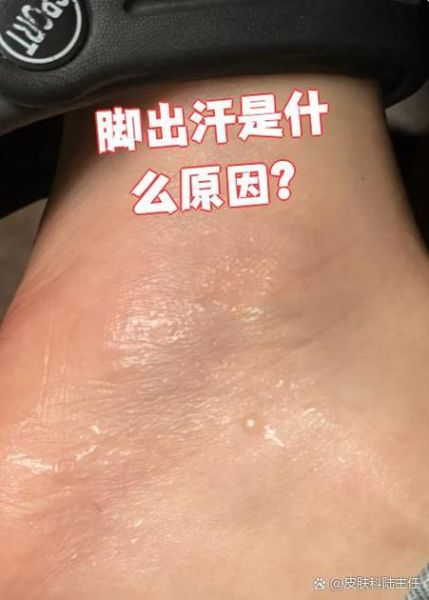 高原出脚汗是什么原因_怎么快速止汗
