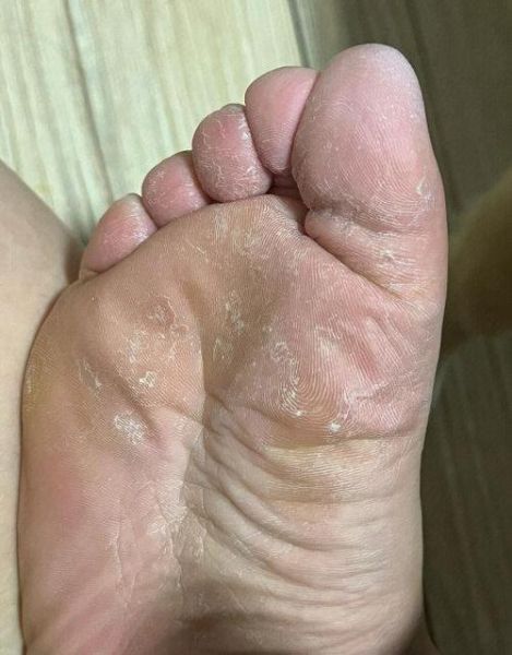 高原出脚汗是什么原因_怎么快速止汗